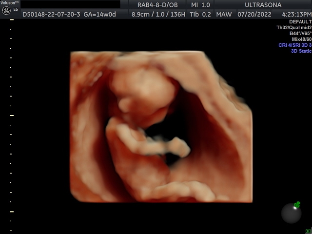 Pregnancy Ultrasound