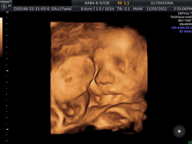 Pregnancy Ultrasound