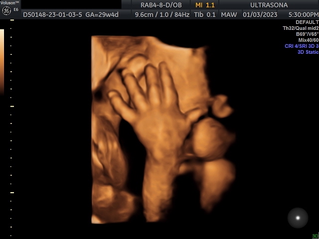 Pregnancy Ultrasound