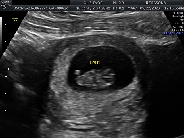 Pregnancy Ultrasound