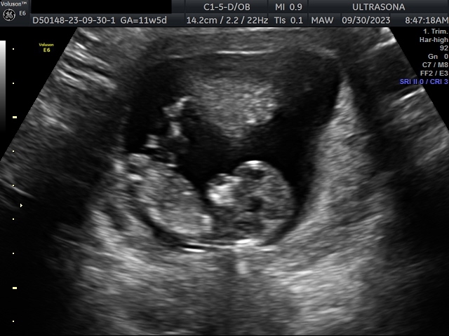 Pregnancy Ultrasound