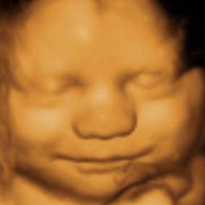 4D Ultrasound