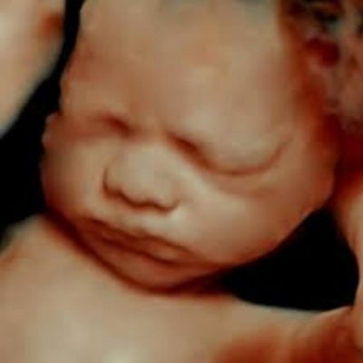 HD Ultrasound